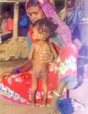 Severely malnourished child
