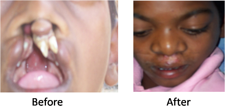 Speciality Camp-Plastic Surgery-This boy could not talk properly since birth, could not eat properly