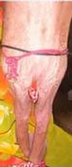 Close-up of a child's severely wasted legs before treatment